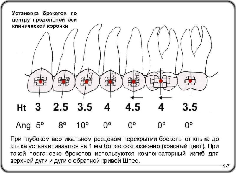 Высота позиционирования брекетов MBT
