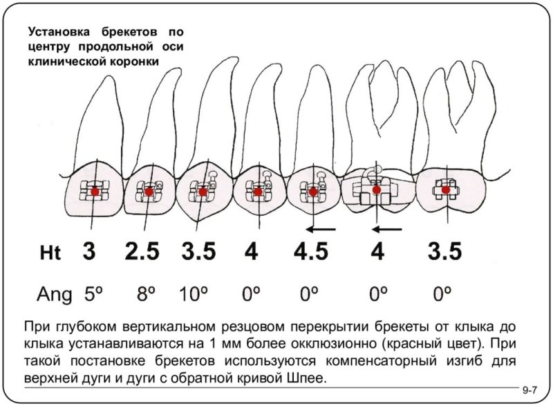 Высота позиционирования брекетов MBT